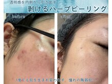 ラウレア オハナ(Laulea ohana)の雰囲気（再生を目的としたハーブピーリング。驚きの改善力はハーブリプロ）