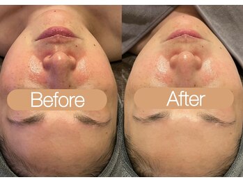 クレヴィア バイ サイバーエステ(CREBIA)/赤み/くすみ【ILLUSTRIOUS】