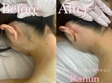 ラナン(Ranun)/経皮吸収42倍のVIOにも優しい♪