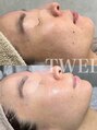 トゥウィーサロン 梅田(Tweesalon)&nbsp;30歳をこえて、毛穴/たるみ/ハリに注目してます！
