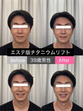 ビオナス 高田馬場店(BIONAS)/エステ版チタニウムリフト症例♪