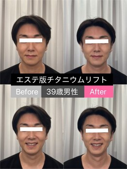 ビオナス 高田馬場店(BIONAS)/エステ版チタニウムリフト症例♪