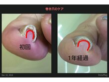 ドクターネイル爪革命 江戸川橋店/重度の巻き爪はコツコツと