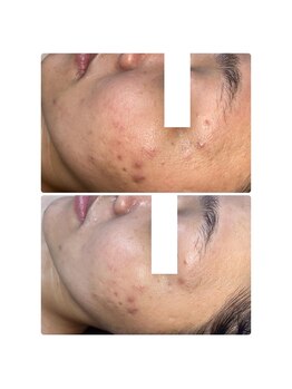 ペア(pe'a)/光フェイシャルbefore★after