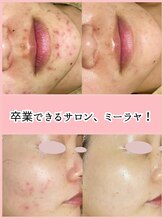 ミーラヤ(MILAYA) 卒業できる 肌質改善