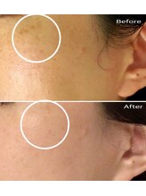 シェアキ(Chez Aki)/シミケアBefore/After