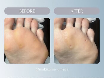 巻き爪補正店 大阪梅田駅前店