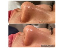 毛穴洗浄・ピーリング。肌をクリーニングし透明感を高めます。