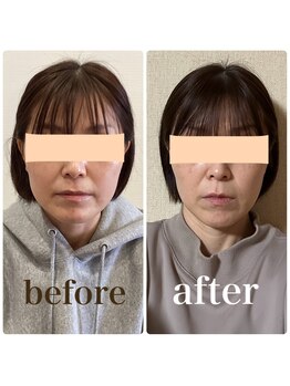 クリーム 京都店(Cream)/あごの形が変わる、希少なエステ