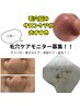 【症例写真モデル募集】毛穴ケア施術￥２２００（鼻の撮影OKのかた限定）