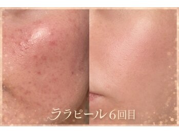 ビジュー(BIJOU)の写真/《肌管理・肌質改善×小顔専門店》日本にいながら韓国レベルのケアが受けられる♪韓国式肌管理で美肌に◎