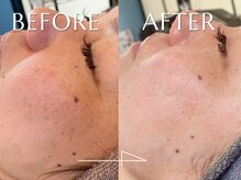 神門 メディカルラボ MEILI院(MedicalLab)/30代 | 女性 | ハーブピーリング