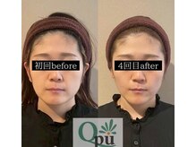 キュープ 富山店(Qpu)/小顔矯正4回