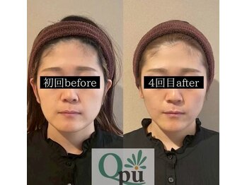 キュープ 富山店(Qpu)/小顔矯正4回