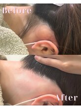 シルビー(CILBE)/うなじミックス脱毛