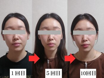 慧仁治療院/食いしばり・むくみ改善