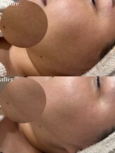 インク(ink)/フェイシャル　MIX脱毛