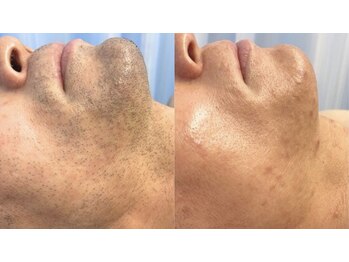 ラクーン(RACCOON)/