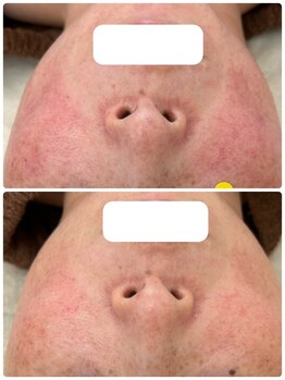 アンド ユー(and.yu)/シミケア・美肌コース1回赤ら顔