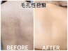 人気No.1◆毛孔性苔癬カウンセリンング【当日施術可】背中ぷつぷつ気になる方