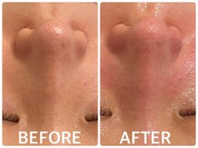 ハーブピーリング 心斎橋/ハーブピーリングで毛穴ケア