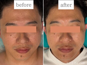 ケリーズ(KELLY `S)/光リフトアップ