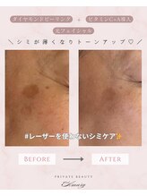 アマリー(Amary)/シミケア：Before→After