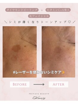 アマリー(Amary)/シミケア:Before→After