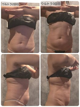 ヴィトワ(Vitowa)/ウルトランスフォーマー施術例14