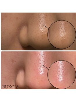 ルクシア(RUXCIA)の写真/[韓国で大人気LDM×ピーリングが通い放題♪]高密度超音波LDM水玉リフティング￥9980!土台から整え水光肌に◎