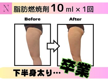 ナチュリ センター南院(NACHUL)/【痩身】脂肪燃焼剤で下半身痩せ