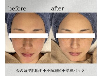 カリス(charis)/速攻小顔！