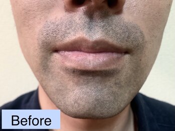 ゴールデンアイ 谷山店(Golden eye)/メンズ髭脱毛