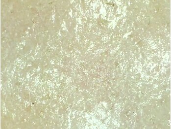 ライゼ(REISE)/ビフォー毛穴(頬)写真【毛穴】