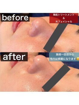 サロンデイジー(Salon Daisy)/REVIハーブピーリング★施術一回