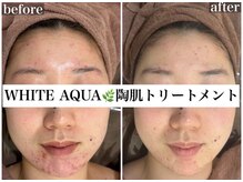 ホワイトアクア 京都店(WHITE AQUA)/ハーブピーリングでニキビケア