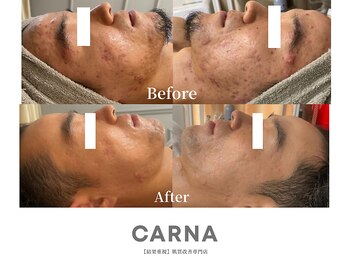 カルナ(CARNA)/凹凸肌もお任せ下さい