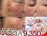 【シミ改善No.1】 シミ集中改善50分(個数・大きさ無制限)頭皮マッサージ付き
