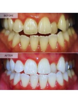 スマイルホワイト 練馬店/ホワイトニングビフォーアフター