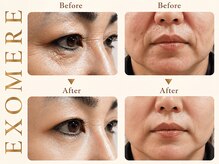 ツキ(TUKI+)の雰囲気（微細針×エクソソームで年齢肌の肌質改善◎韓国発エイジングケア）