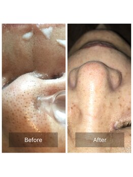 グリーンノート(GREEN NOTE)/毛穴のお掃除