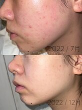 エンジェルワックス 新宿店(Angel Wax)/カーボキシーセラピー♪