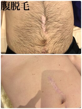 ひとつno武器/メンズ腹脱毛