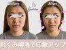 【すぐ小顔になりたい方 】歪み/左右差/たるみ改善の小顔矯正￥19800→￥9980