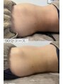 エクラ 五反田(eclat)&nbsp;五反田/肌質改善/eclat/エクラ/インディバ/マッサージ