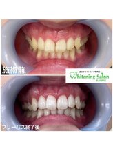 ホワイトニングサロン 名古屋駅店/【ホワイトニング施術例】