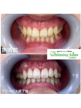 ホワイトニングサロン 名古屋駅店/【ホワイトニング施術例】