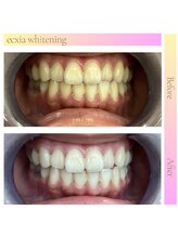 エクシアホワイトニング 草津店/ホワイトニングビフォーアフター
