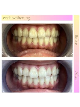 エクシアホワイトニング 草津店/ホワイトニングビフォーアフター
