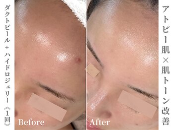 ゼアー(THERE FY.)/敏感肌さんの色むら改善